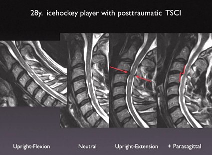 Icehockey Player with Posttraumatic Transient Spinal Cord Injury (TSCI)