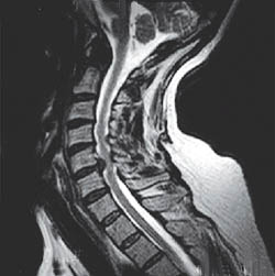 Unsuspected Disc Herniation on Extension