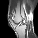 MRI of the knee