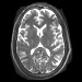 MRI of the brain