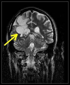 MRI of Brain Tumor