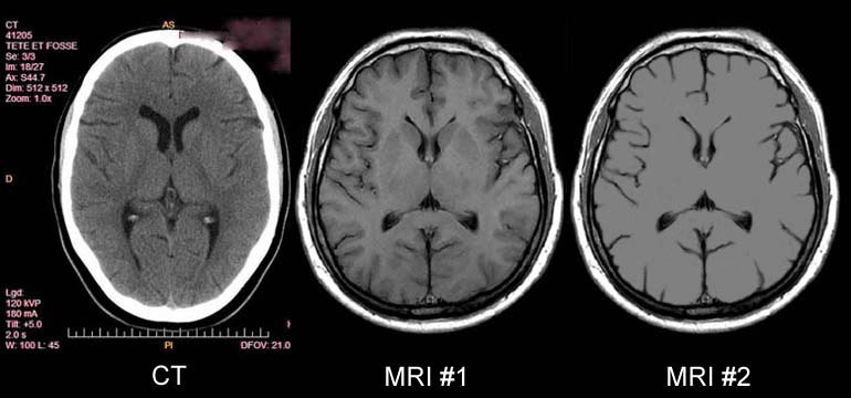 MRI image vs. CT image