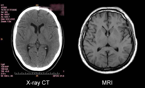 CT image Vs. MRI Image