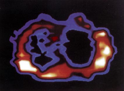 Figure 23a. FONAR scan at the level of 1-3/4 in below Angle of Lewis in a man 46 years old with pulmonary oat cell carcinoma. Tumour indicated by light blue infiltrate in left lung field, which should be black as it is in right lung cavity. Midline structure (red) separating the two lung cavities is the cross section through the arch of the aorta.
