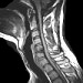MRI of the cervical spine