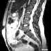 MRI of the lumbar spine