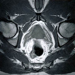 T1 MRI of the Prostate