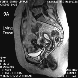 MRI of the bladder and uterine prolapse