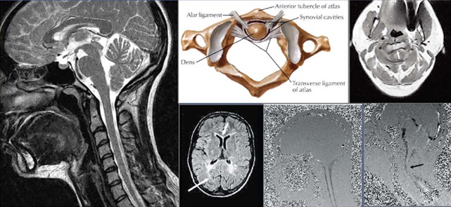The Cranio-Cervical Syndrome (CCS):