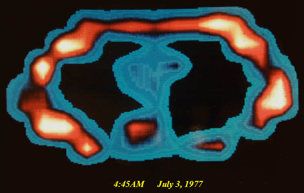 First ever MR image of the human body, a cross-section of L. Minkoff's chest at the level of T-8