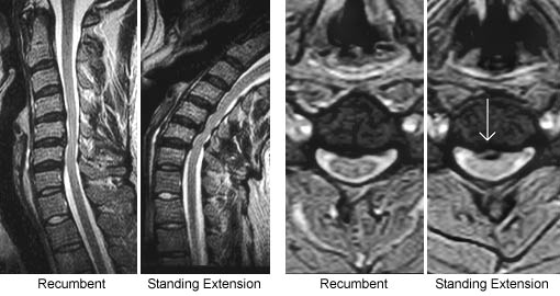 Fluctuating Spinal Stenosis and Position-Dependent Disc Herniation
