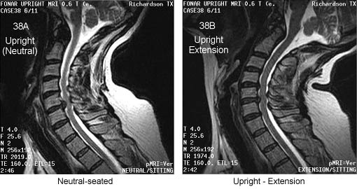 Surgical Plans Altered by an Upright Flexion-Extension MRI Examination