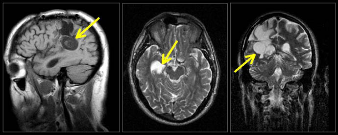 Fig 9. Brain Tumor