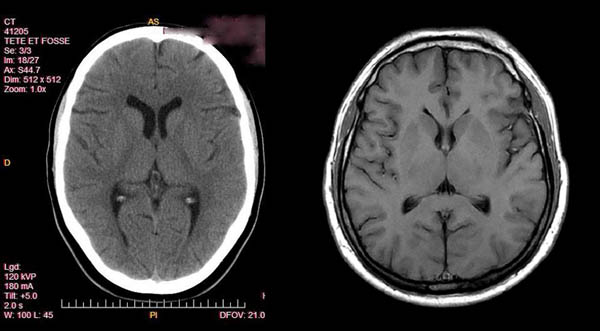 Figure 12. Note the soft tissue detail visualized in the MRI image of the brain that is not visualized by x-ray CT technology (e.g. the pronounced white matter-grey matter differentiation of the MRI, the clearly defined thalamic nuclei, and the well visualized subdural layers not visualized by CT.)