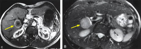 Fig.11. Liver Tumor